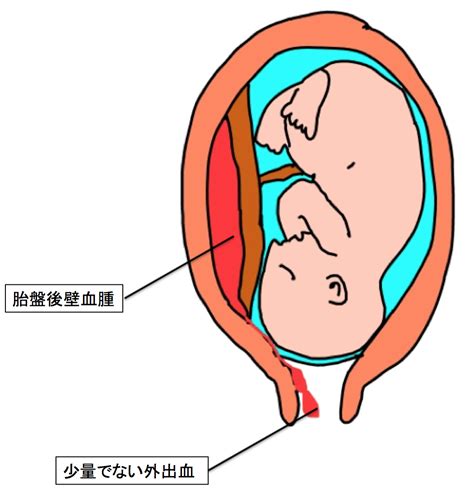 胎盤剝離後期|胎盤がはがれる、常位胎盤早期剥離について｜東京・世田谷での 